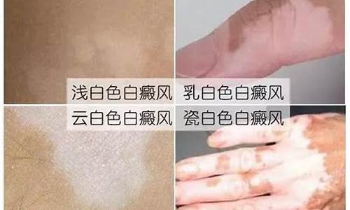 后天白斑病是怎么得的_后天白癜风是什么原