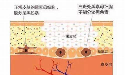 夏季白癜风高发的原因有哪些_夏天出现白斑